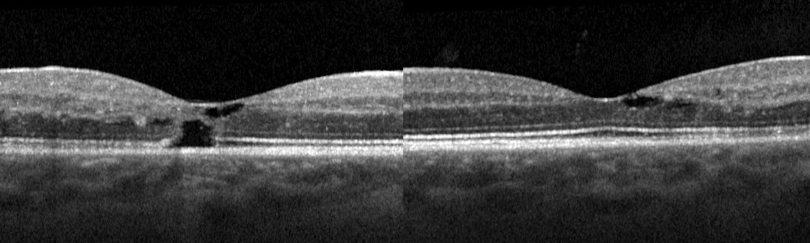 Optical coherence tomography demonstrates cystic degeneration at the temporal margin of both foveae. In the right eye this has led to a partial thickness macular hole.