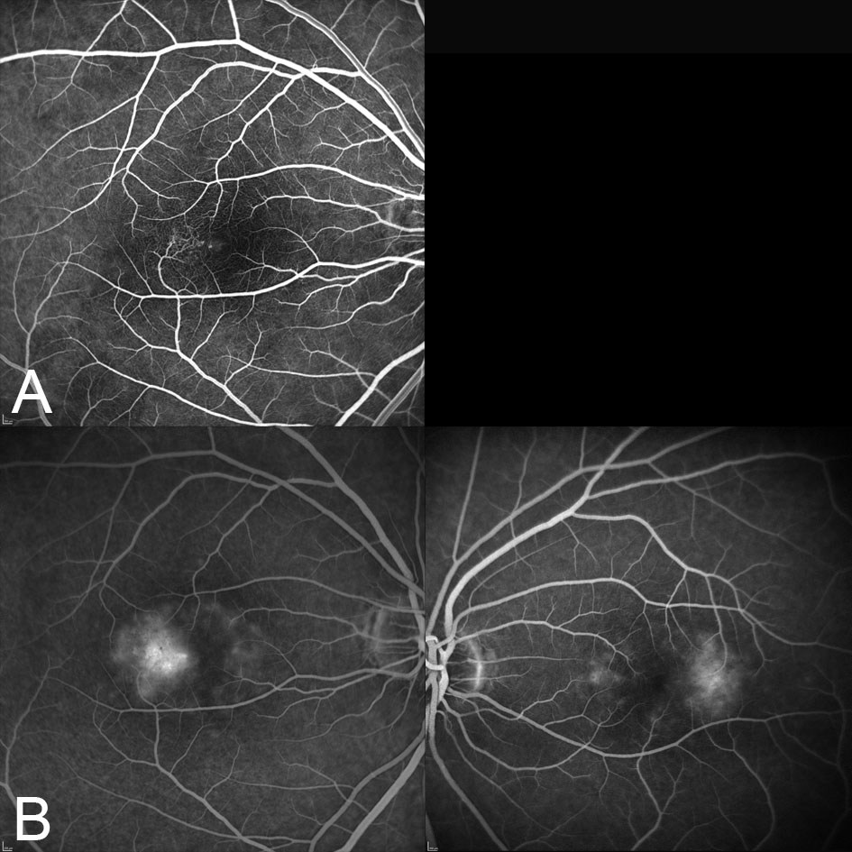 Fluorescein angiography shows hyperfluorescent leakage temporal to both foveae from the early (A) to late (B) phases.