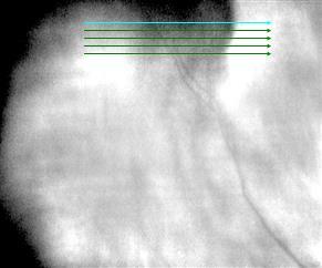 Near-infrared imaging shows the lesion to be dark.