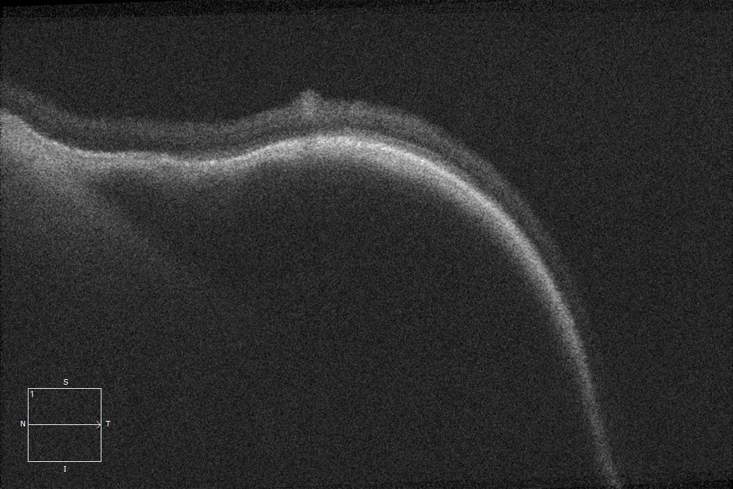 Optical coherence tomography shows a large cavernous hyporeflective space beneath the retinal pigment epithelium.