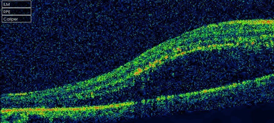 Right optical coherence tomography (horizontal raster scan) through the macula at presentation demonstrated subretinal fluid and hard exudate.