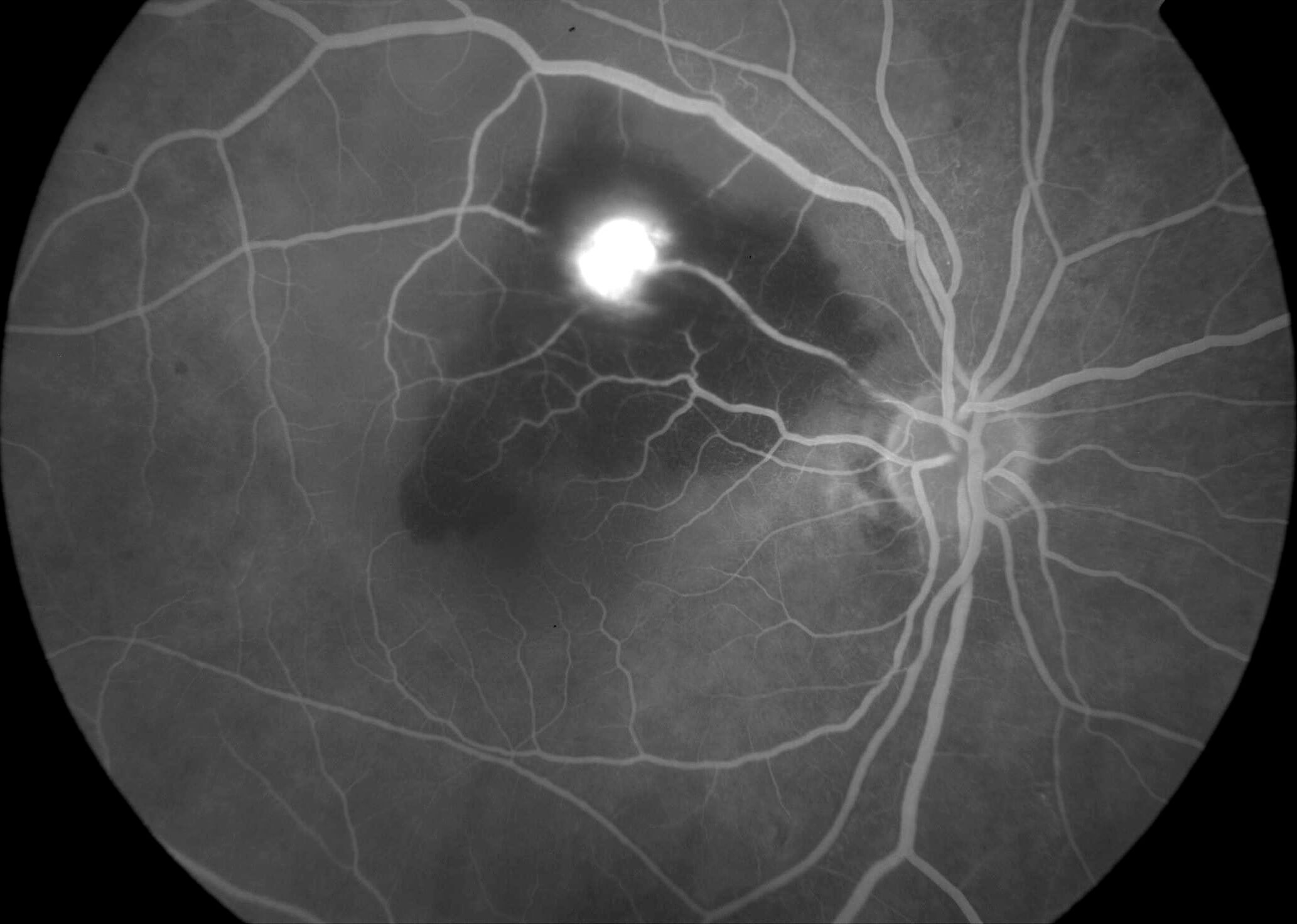 Right fundus fluorescein angiography demonstrates a leaking saccular retinal artery macroaneurysm at the centre of the multilayered retinal hemorrhage.