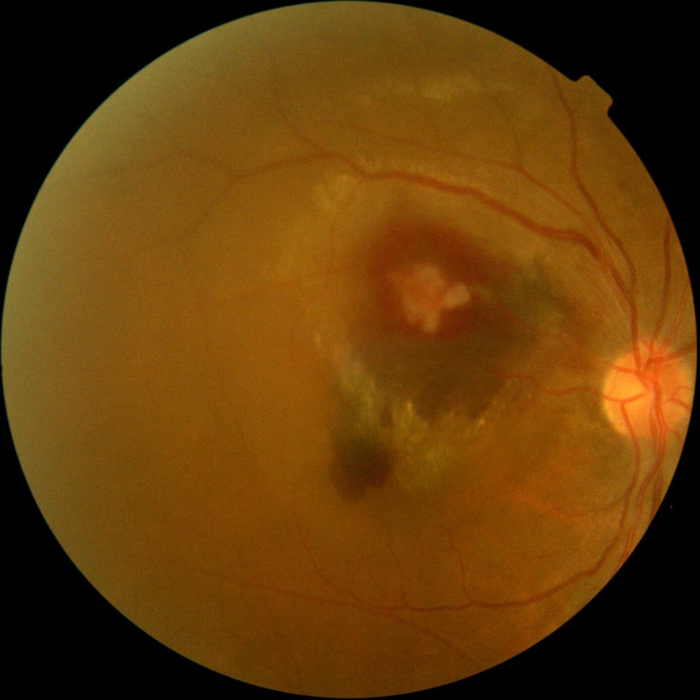 Colour photograph immediately following argon laser treatment of the macroaneurysm.