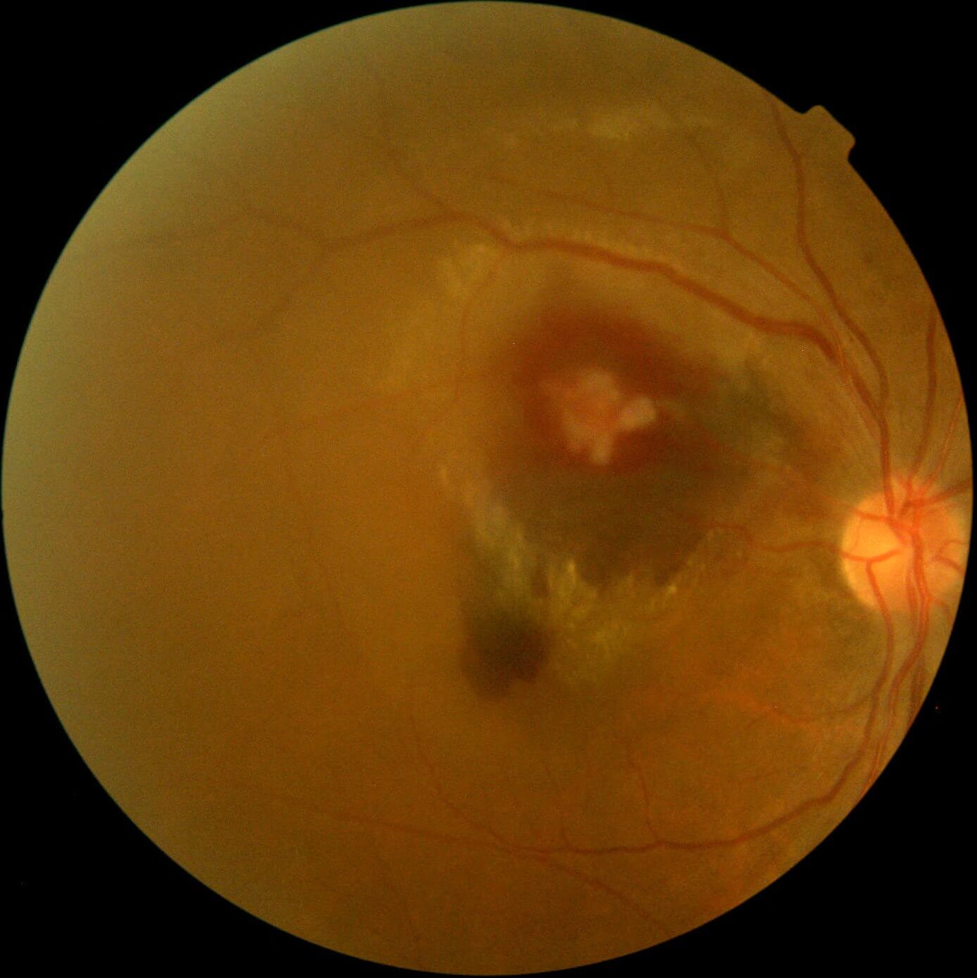 Colour photograph immediately following argon laser treatment of the macroaneurysm.