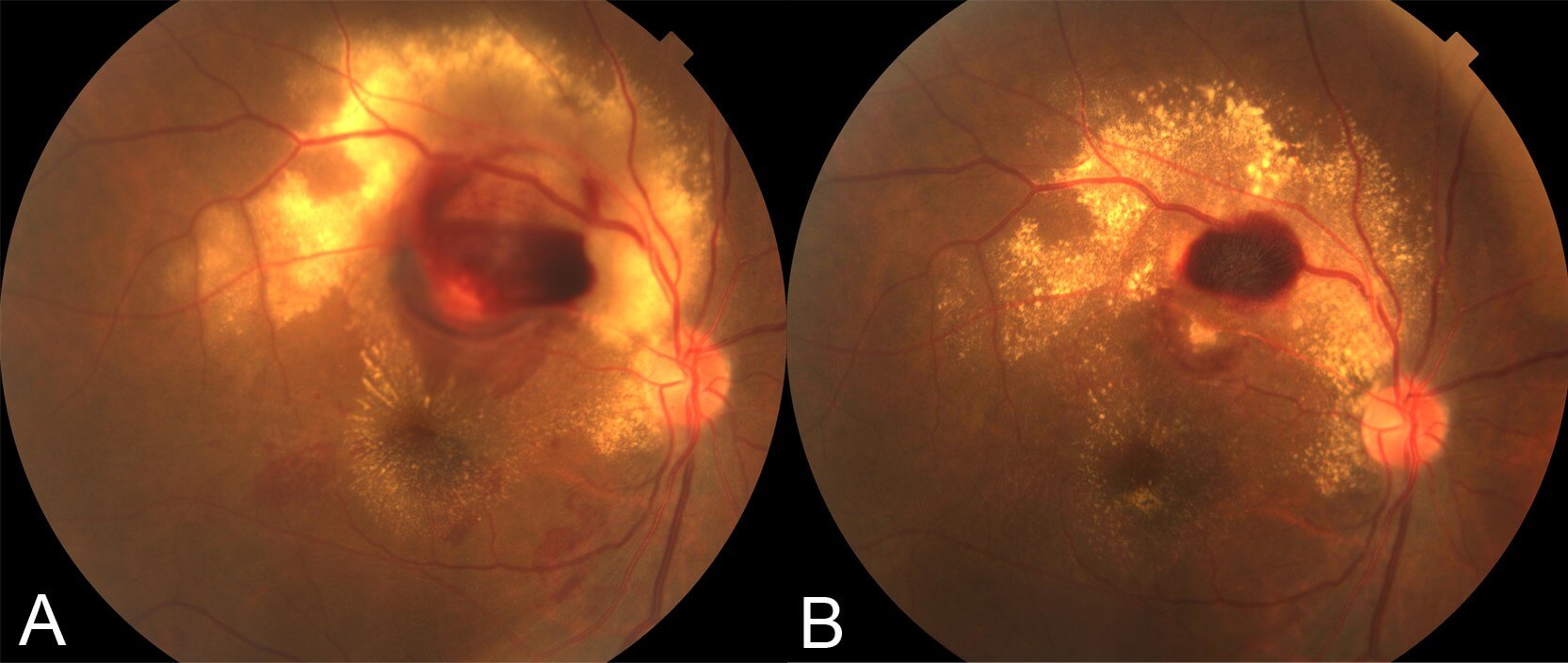 A) At one month following laser the subretinal fluid had cleared from the macula. There is significant lipid deposition evident. B) At four months following laser the lipid and haemorrhage is resorbing. The thrombosed macroaneurysm is seen inferior to the residual superficial retinal haemorrhage. Visual acuity is 6/24 at this stage.