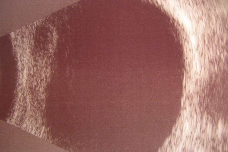 Right and left optical coherence tomography scans. There is subretinal fluid at the right macula.