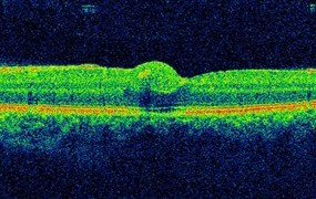 A sub-ILM hyper-reflective mass is seen at the fovea.