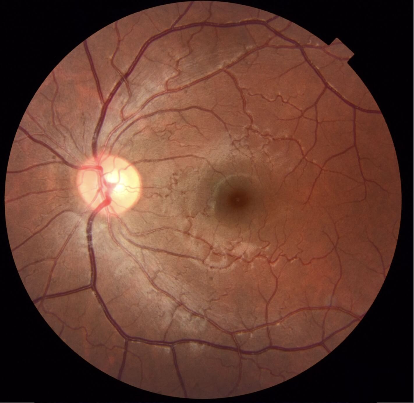 Six weeks later the macula haemorrhage had resolved with conservative management. There was no deep retinal or choroidal pathology visible once the blood had cleared.