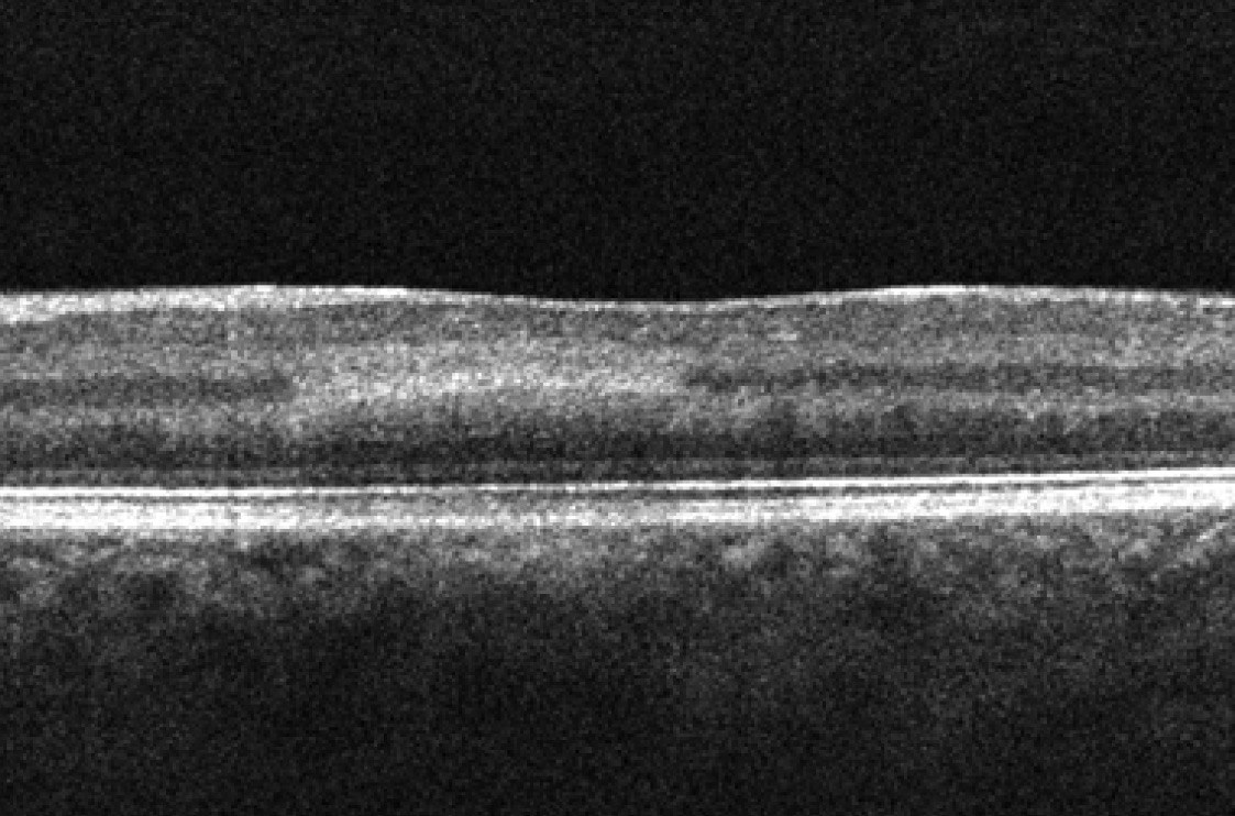 Optical coherence tomography just inferior to the left fovea demonstrates a hyper-reflective band at the inner nuclear layer.