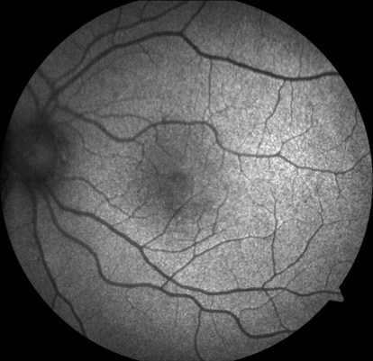 Fundus autofluorescence of the left eye is normal.