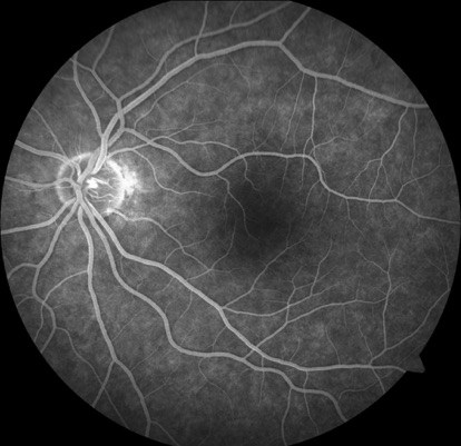 Fundus fluorescein angiography of the left eye is normal, with no evidence of vascular occlusion.