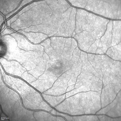 Near infra-red reflectance shows a dark, wedge-shaped lesion pointing towards the fovea, corresponding to the retinal lesion seen on fundus exam.