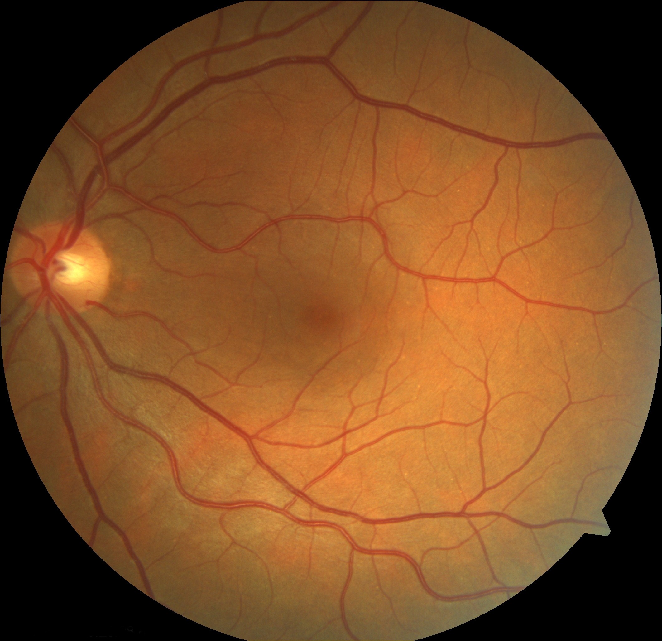 Near infra-red reflectance shows a dark, wedge-shaped lesion pointing towards the fovea, corresponding to the retinal lesion seen on fundus exam.