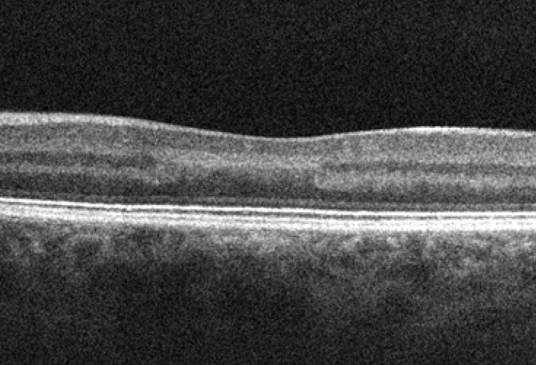 Near infra-red reflectance shows a dark, wedge-shaped lesion pointing towards the fovea, corresponding to the retinal lesion seen on fundus exam.