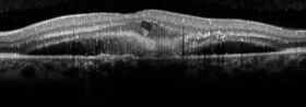 OCT demonstrating sub and intraretinal fluid in the left macula, and an isolated PED in the right eye.