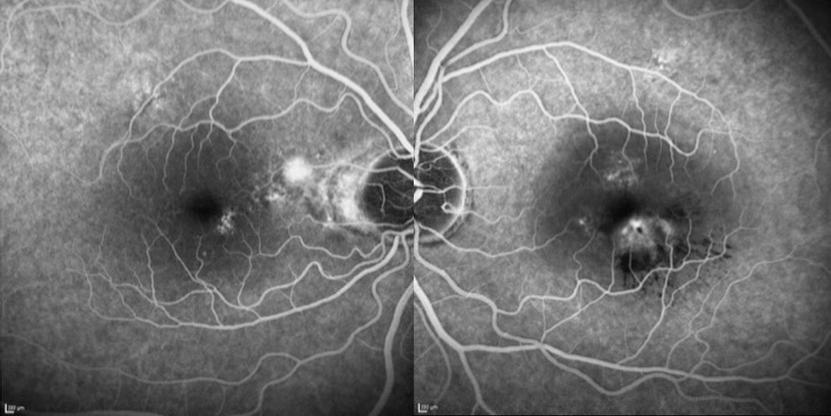 Fluorescein angiography of the left eye (A) demonstrates leakage inferior to the fovea and several pinpoint areas of hyperfluorescence. In the right eye (B) there is pooling within a serous PED temporal to the optic nerve and stippled fluorescence towards the fovea.