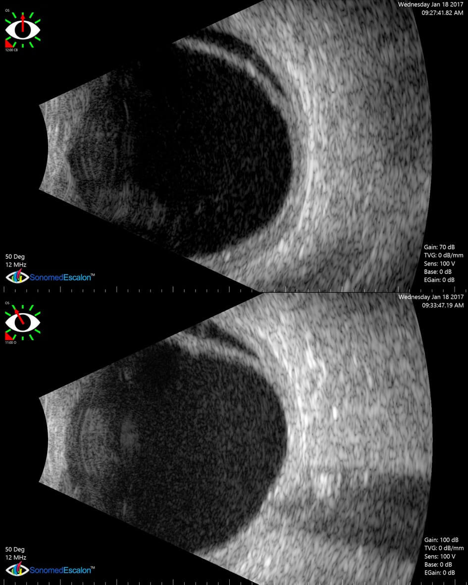 B-scan ultrasonography demonstrates a vitreous haemorrhage and splitting of the eye wall superonasally. The transverse T12 scan looks at the superior retina, with the top of the image nasal. The longitudinal L1030 scan looks from anteriorly at the ciliary body (top of the image) to posteriorly at the optic nerve (bottom of the image) in the 1030 meridian.