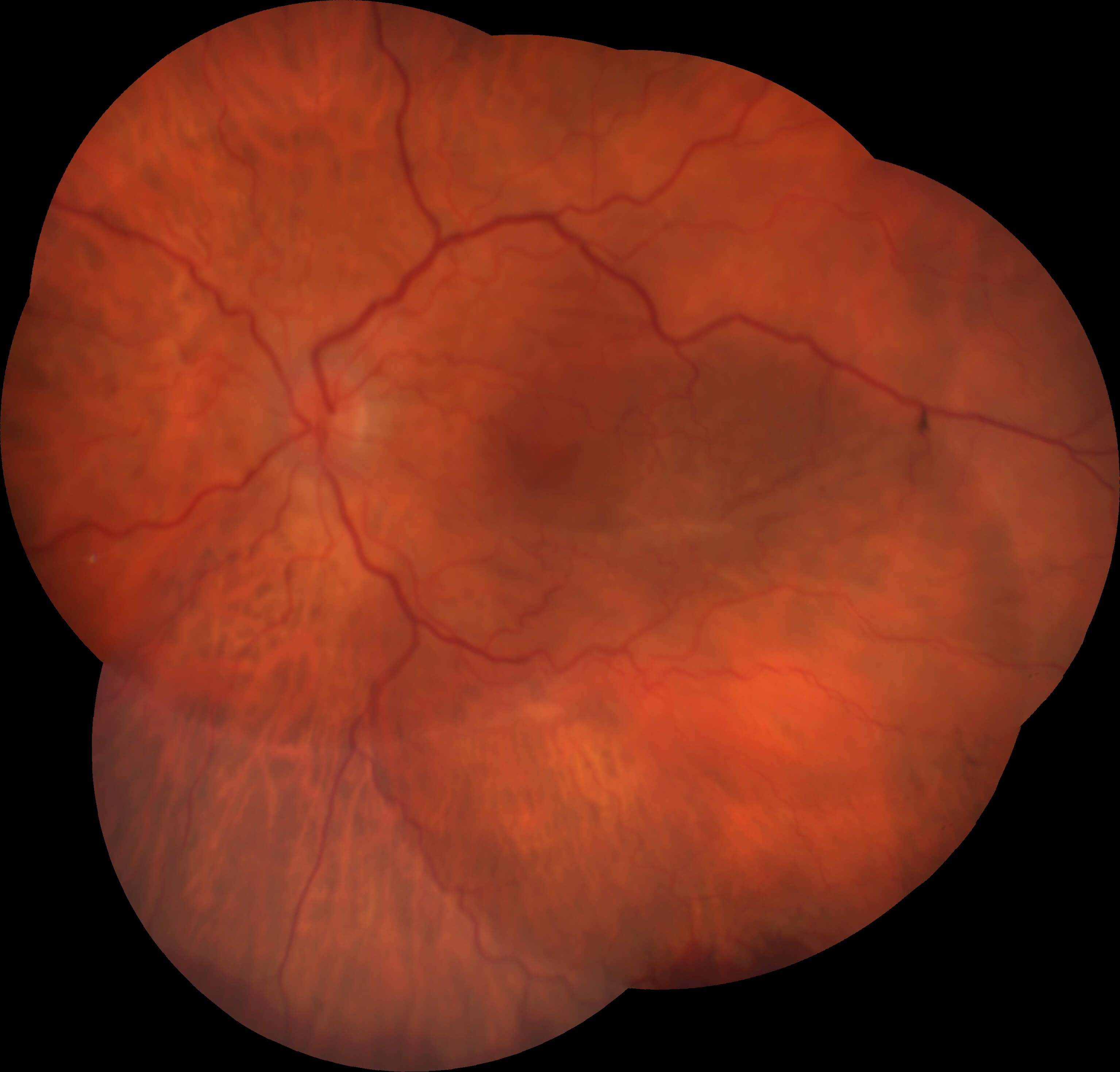 Colour montage photograph of the left eye shows choroidal folds at the macula due to hypotonous maculopathy.