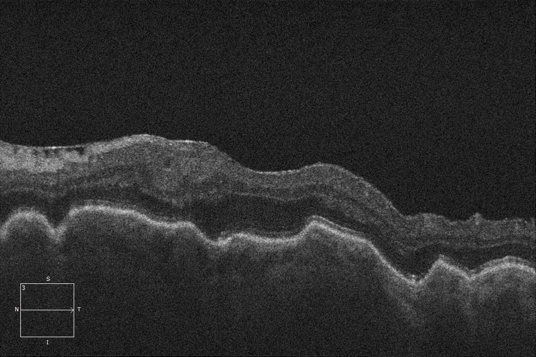 Optical coherence tomography of the left macula shows choroidal folds due to hypotony.