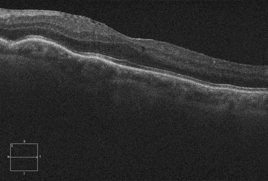 Following repair of the cyclodialysis cleft, the intraocular pressure normalised and the choroidal folds resolved.