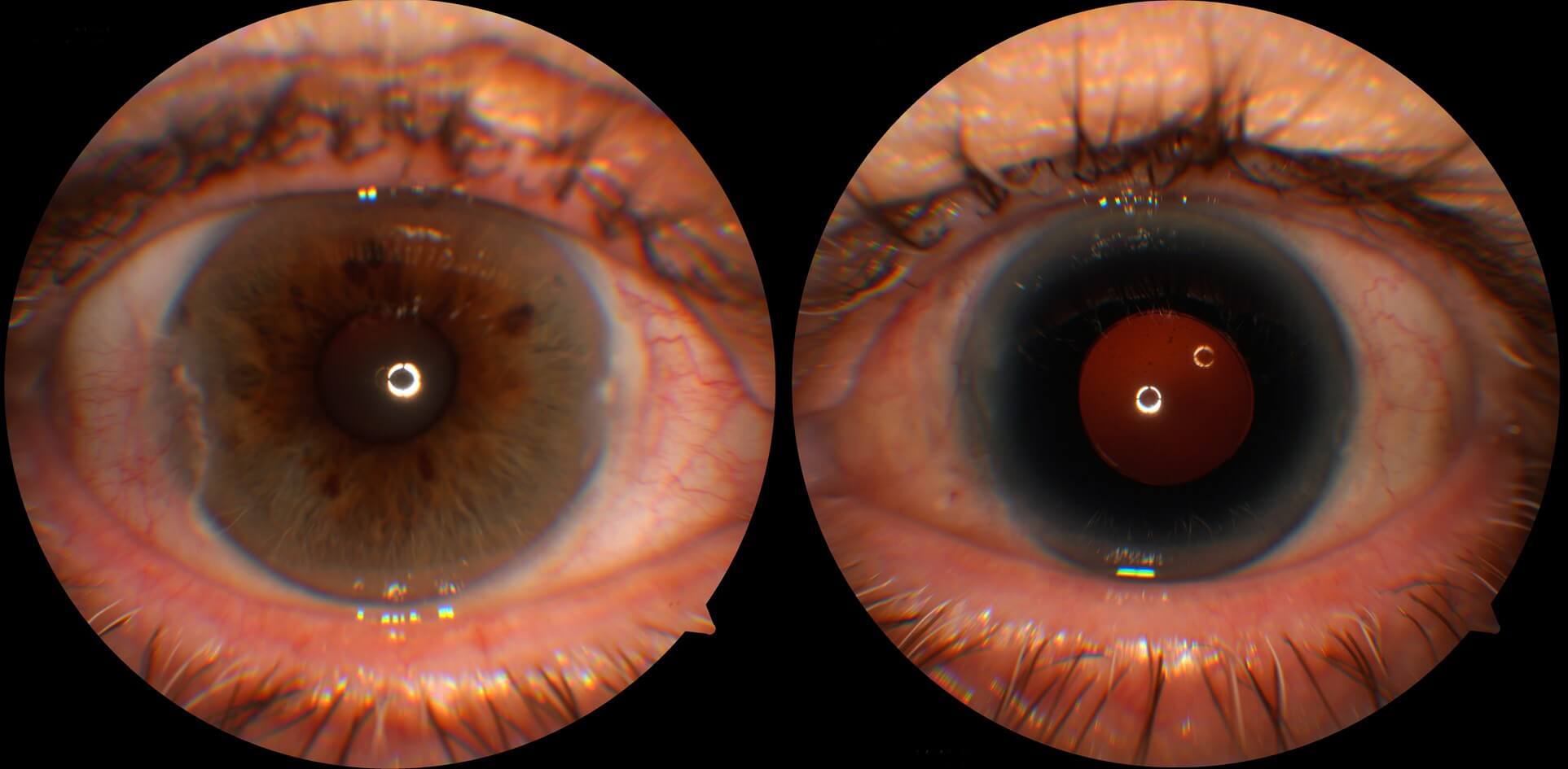 Colour photographs of the right and left eyes. The right eye is normal. The left eye has a Morcher Type 68 Intraocular lens that has been sutured internally to the sclera. This intraocular lens has a prosthetic iris.