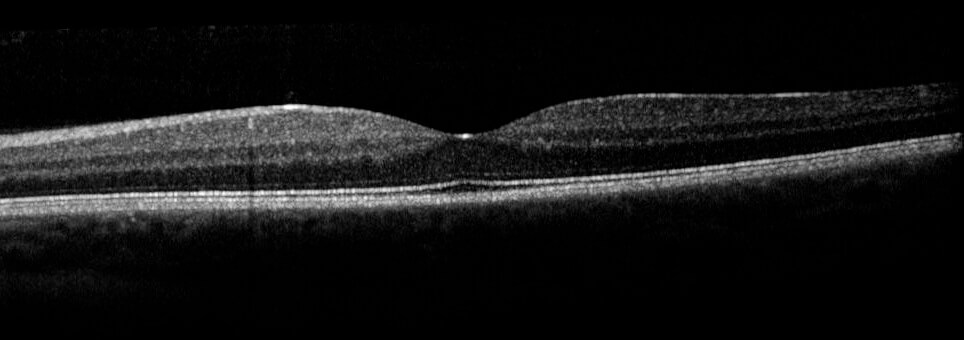 Optical Coherence Tomography of the left macula is normal.