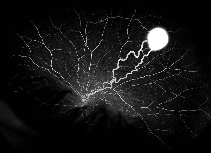 Fluorescein angiography of the left fundus shows early hyperfluorescence of the vascularized lesion with feeding retinal arteriole and draining venule.