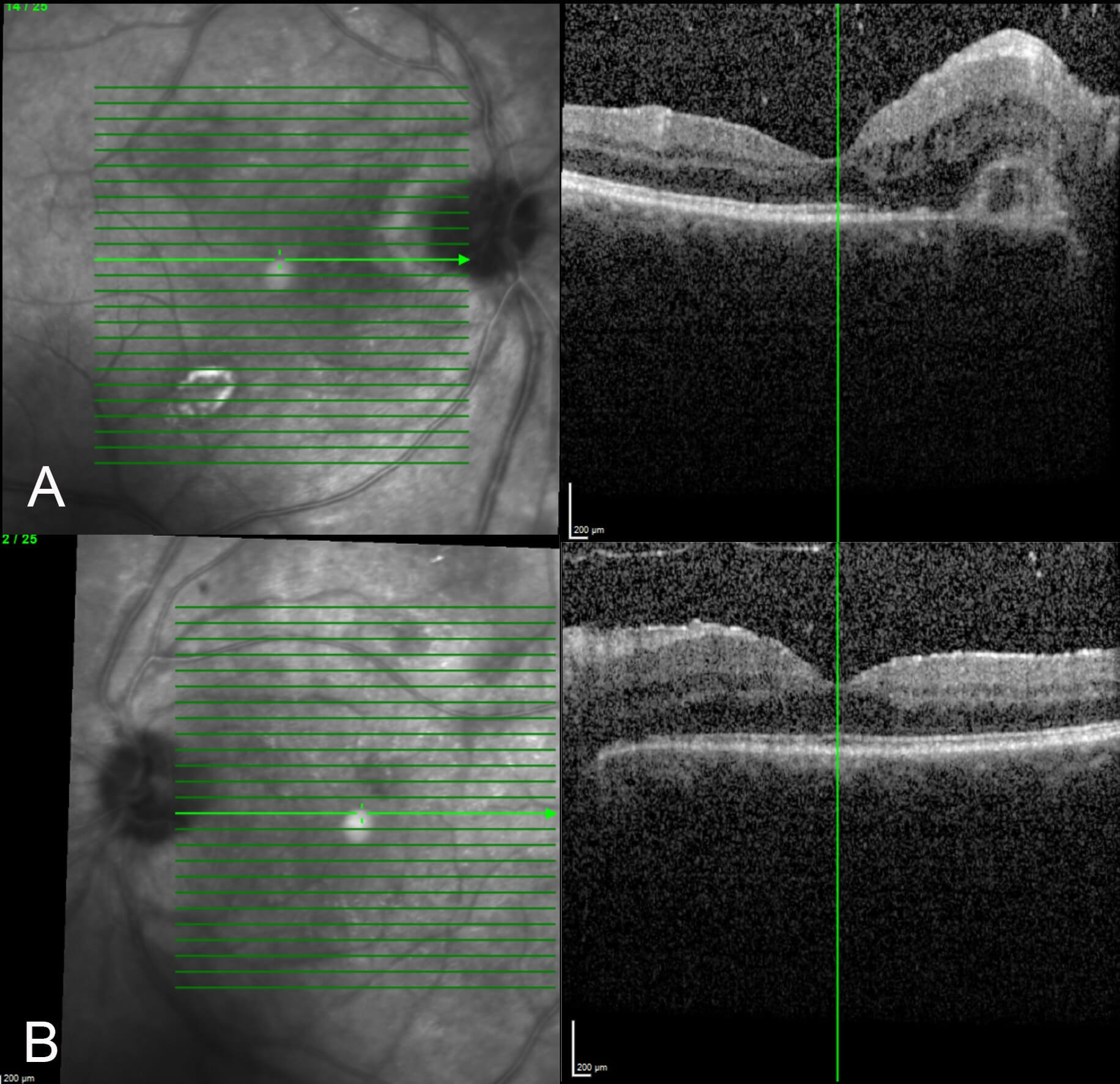 A) Optical coherence tomography through the right macula shows a subretinal hyper reflective lesion close to the optic disc with some subretinal and intraretinal fluid. The fovea is just spared. Vitreous cells are present. B) In the left eye there is some retinal thickening with a few intraretinal cystic changes close to the optic disc. Some vitreous cells are also present.