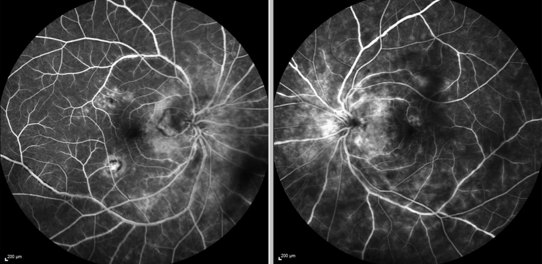 Fundus fluorescein angiography shows bilateral hyperfluorescent vasculitis with irregularity of the retinal vessel calibre, some disc leakage and choroidal neovascular membranes both temporal to the right optic disc and inferotemporal to the fovea.