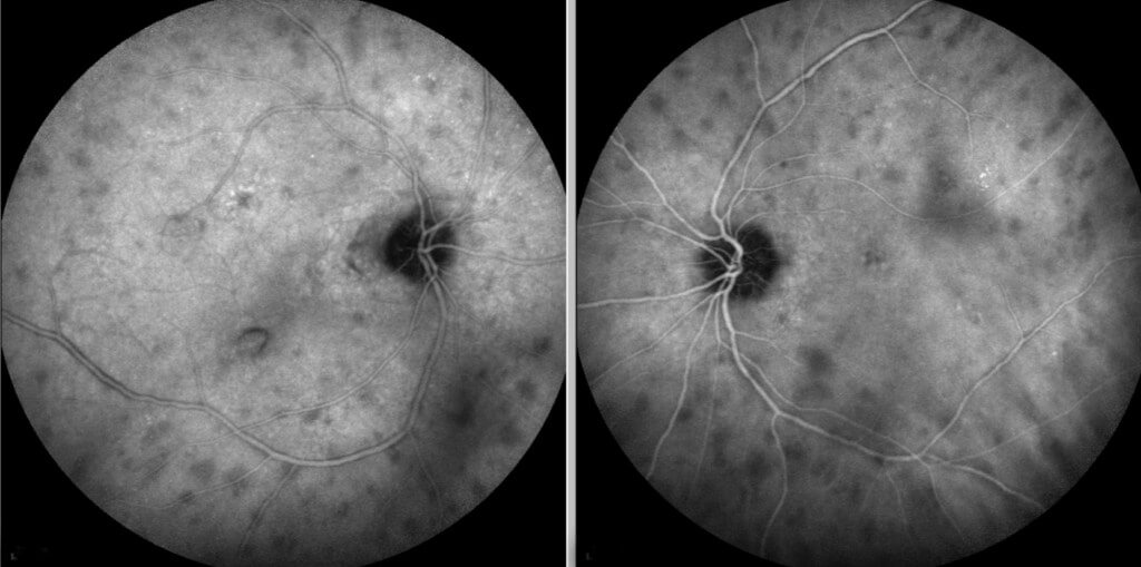 Late phases of indocyanine green angiography shows multiple bilateral hypo-fluorescent choroidal spots.