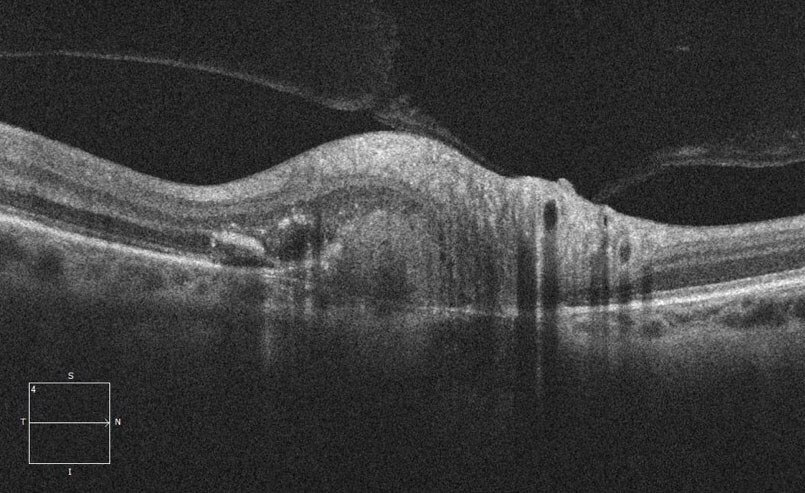 Optical coherence tomography (OCT) through the affected inferotemporal optic nerve demonstrates a hyper-reflective subretinal elevation.