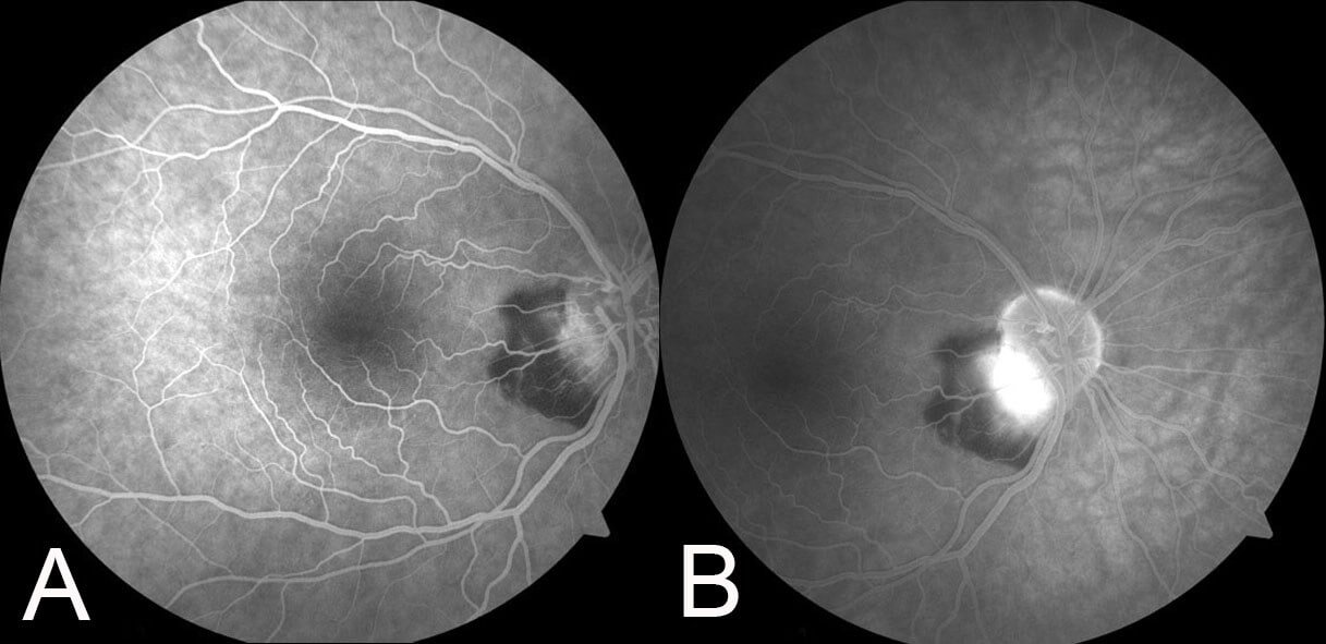 Early (A) and late (B) fundus fluorescein angiography demonstrates an area of increasing hyperfluorescence. Adjacent to this is an area of blocked fluorescence due to the overlying haemorrhage.