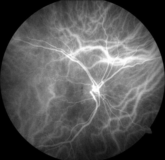 Indocyanine green angiography did not demonstrate any polyps.