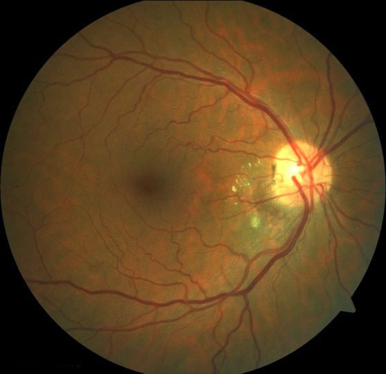 Colour fundus photograph demonstrating resolution of the haemorrhage and mild residual hard exudate.