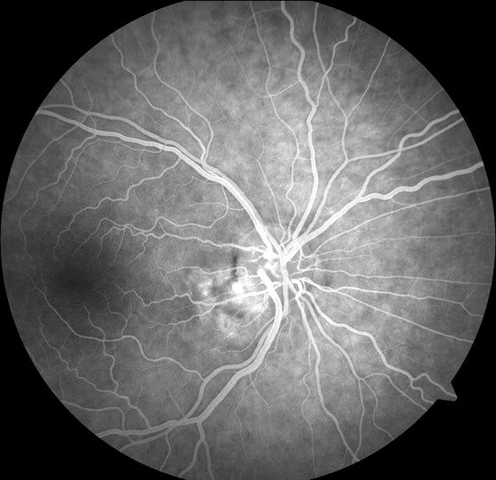 Repeat FFA demonstrating a residual area of focal hyperfluorescence which was treated with focal laser photocoagulation.