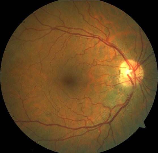 Colour fundus photograph demonstrating complete resolution of the clinical findings.