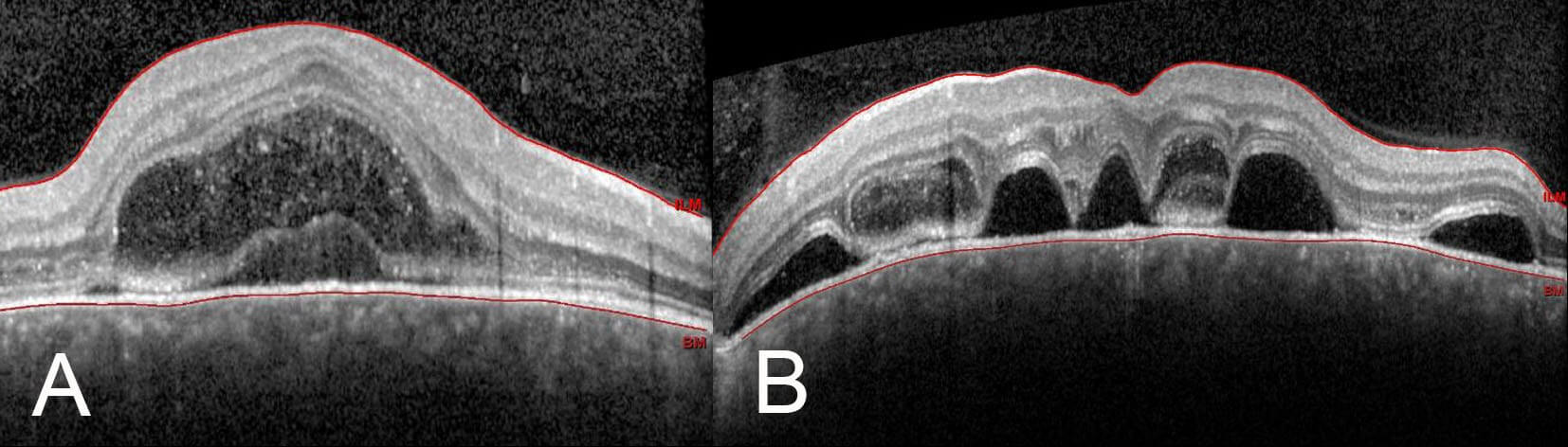 Optical coherence tomography shows multiple bilateral exudative retinal detachments, outer retinal cysts and thickened choroids.