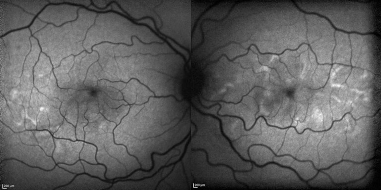 Fundus autofluorescence shows hyperfluorescsent areas corresponding to the subretinal fluid.