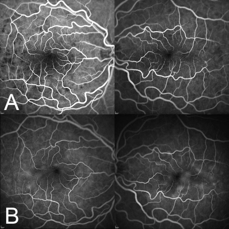 Fluorescein angiography demonstrates hypo fluorescent spots in the early phases A), with pin-point hyperfluorescence and hyperfluorescent pooling in the later phases B).
