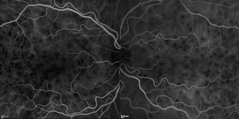 Indocyanine green angiography shows multiple hypofluorescent spots.