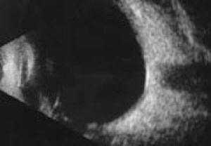 B-scan ultrasound shows a thickened choroid , but no evidence of posterior scleritis.