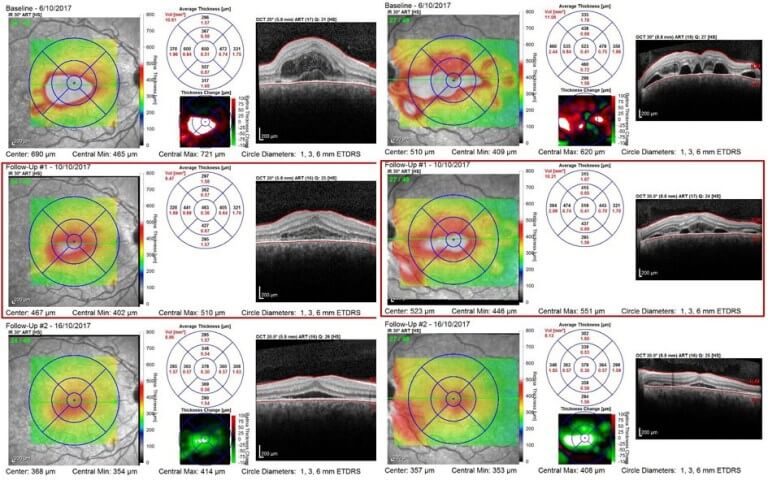 Progression OCT scans over 10 days shows reduction of subretinal fluid, intraretinal fluid and thinning of the choroids