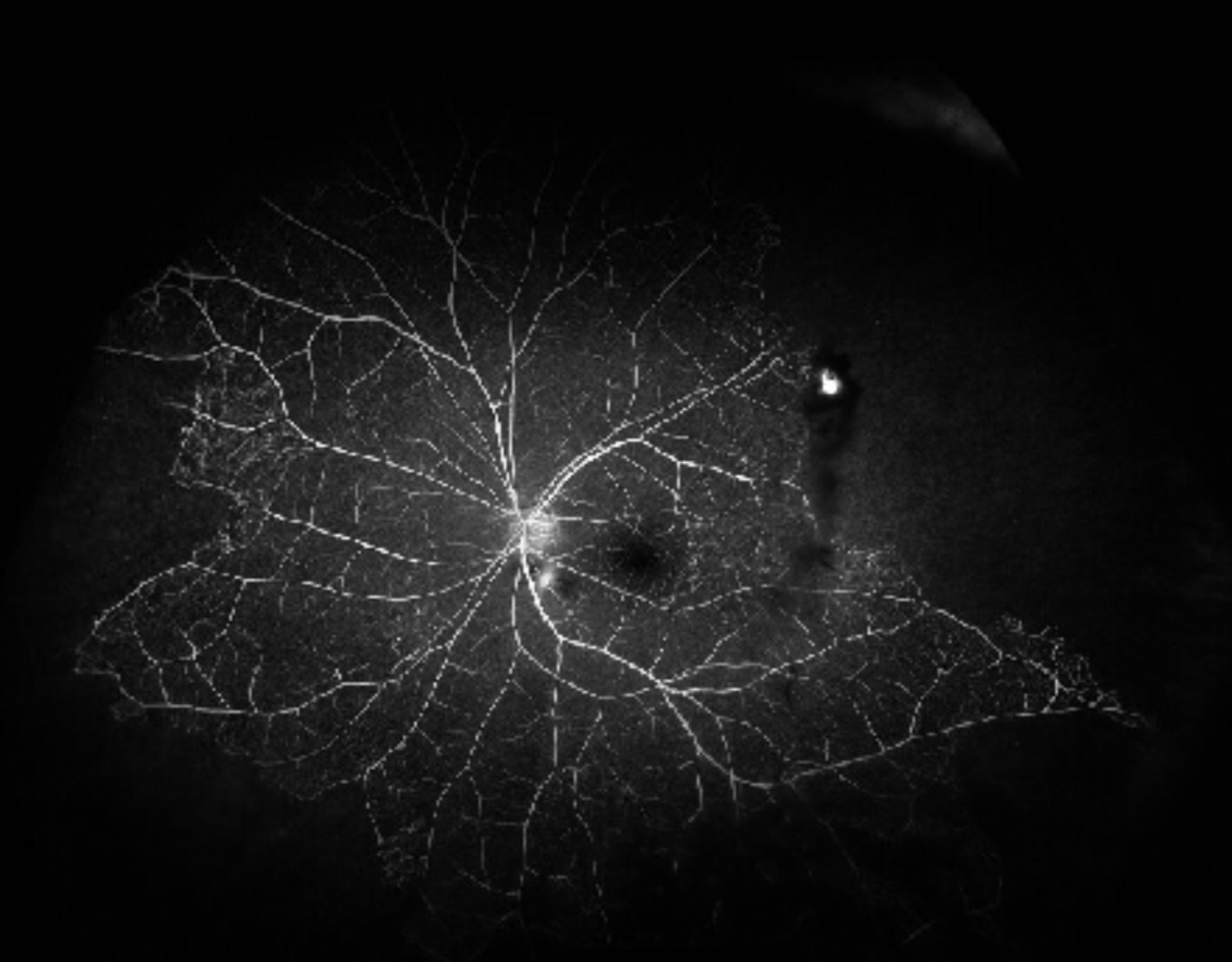 Optical coherence tomography shows multiple bilateral exudative retinal detachments, outer retinal cysts and thickened choroids.