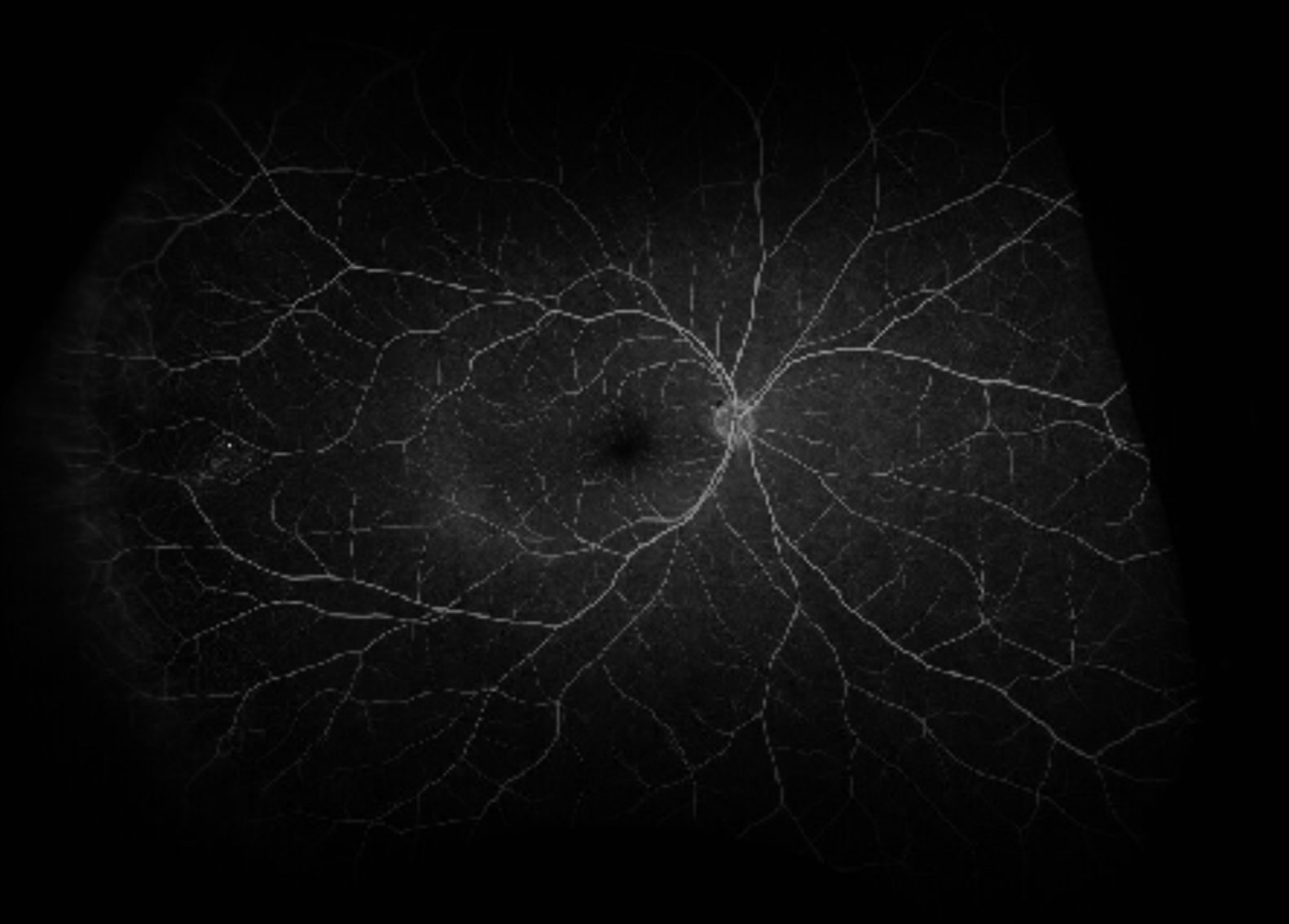 Fluorescein angiography demonstrates hypo fluorescent spots in the early phases A), with pin-point hyperfluorescence and hyperfluorescent pooling in the later phases B).