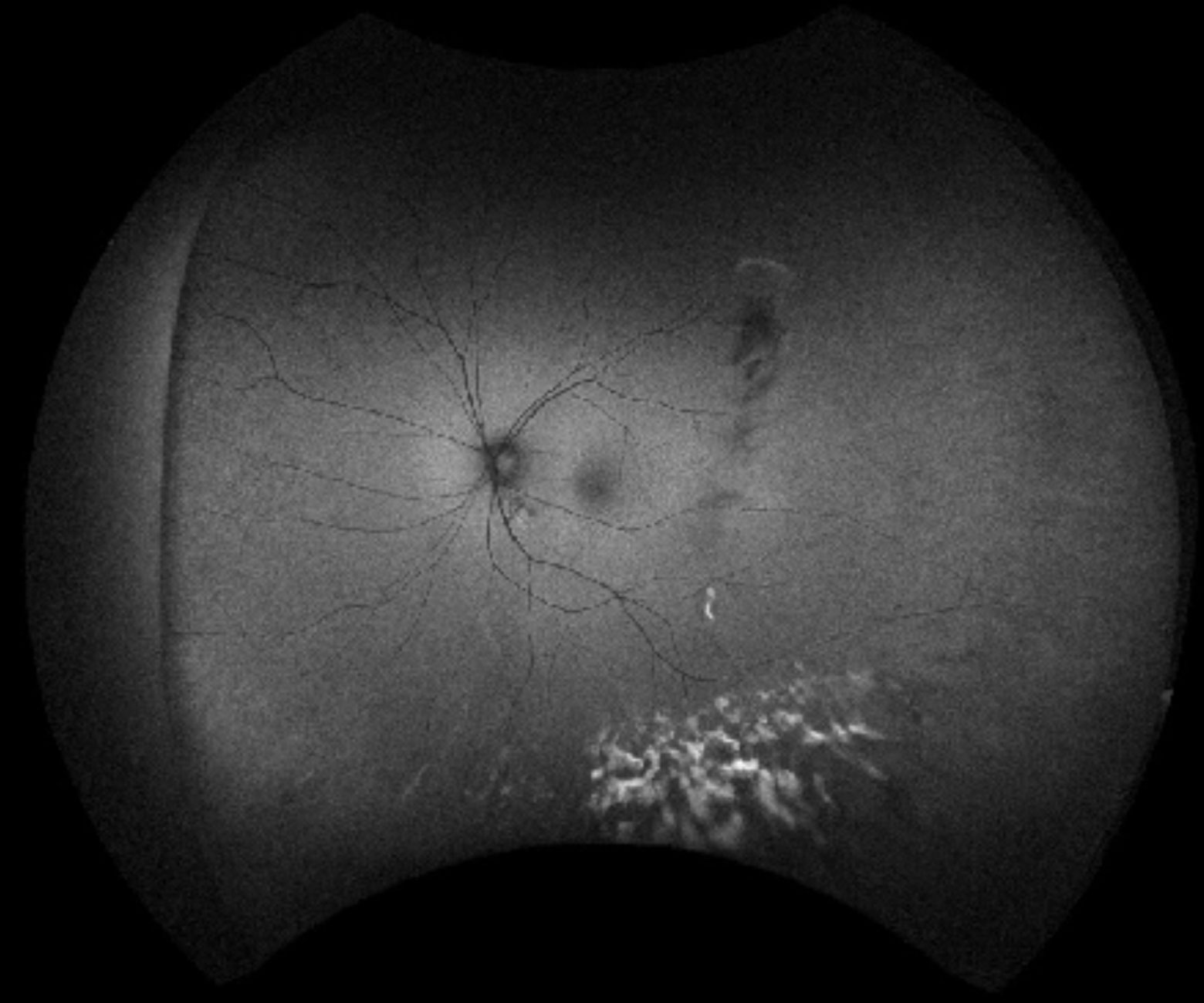 Indocyanine green angiography shows multiple hypofluorescent spots.