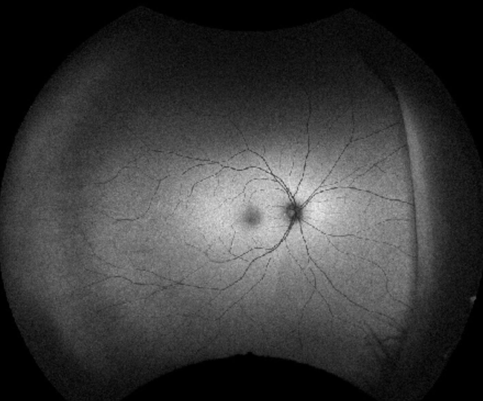 B-scan ultrasound shows a thickened choroid , but no evidence of posterior scleritis.