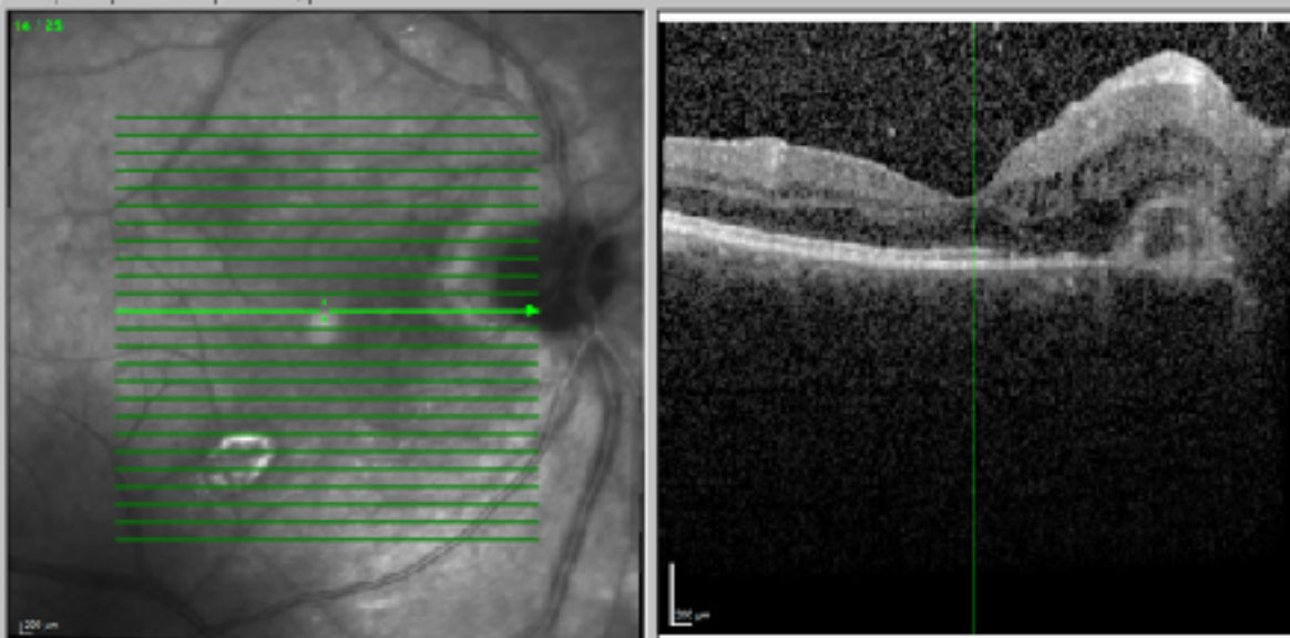 Optical coherence tomography shows multiple bilateral exudative retinal detachments, outer retinal cysts and thickened choroids.