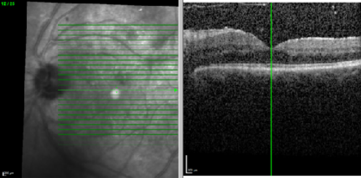 Fluorescein angiography demonstrates hypo fluorescent spots in the early phases A), with pin-point hyperfluorescence and hyperfluorescent pooling in the later phases B).