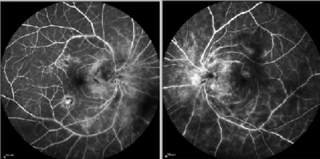 Indocyanine green angiography shows multiple hypofluorescent spots.