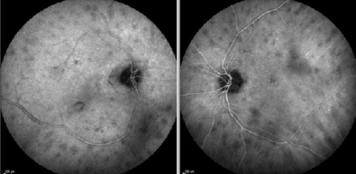 B-scan ultrasound shows a thickened choroid , but no evidence of posterior scleritis.